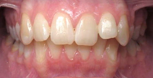 Teeth before clear aligners — Schumer Dental Tucson