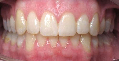Teeth after clear aligners — Schumer Dental Tucson