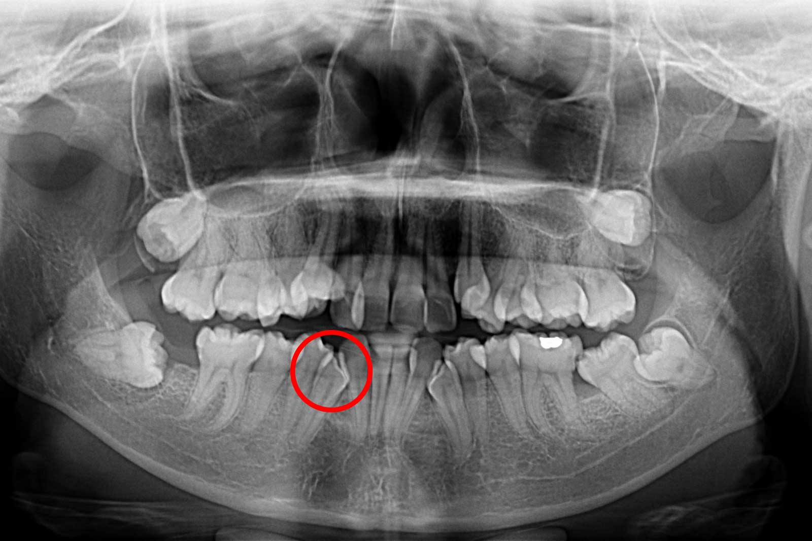 Impacted Canine Tooth Schumer Dental Pc