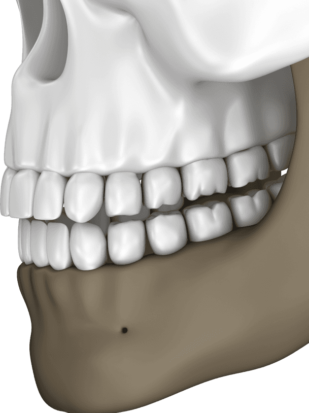 Overbite Tucson | Schumer Dental, PC