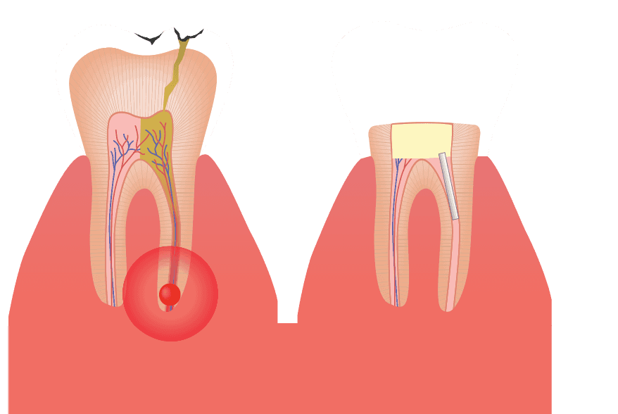 Endodontics Tucson Schumer Dental, PC